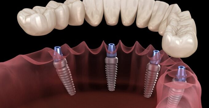 Discover the Future of Dentistry with 4 in 1 Implants: A Comprehensive Guide