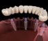 Discover the Future of Dentistry with 4 in 1 Implants: A Comprehensive Guide